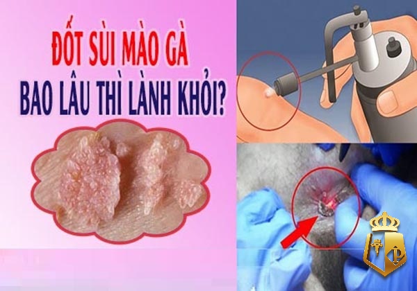 sui mao ga la gi cach dieu tri the nao cung typhu88 tim hieu 44 - Sùi mào gà là gì? Cách điều trị thế nào? Cùng typhu88 tìm hiểu